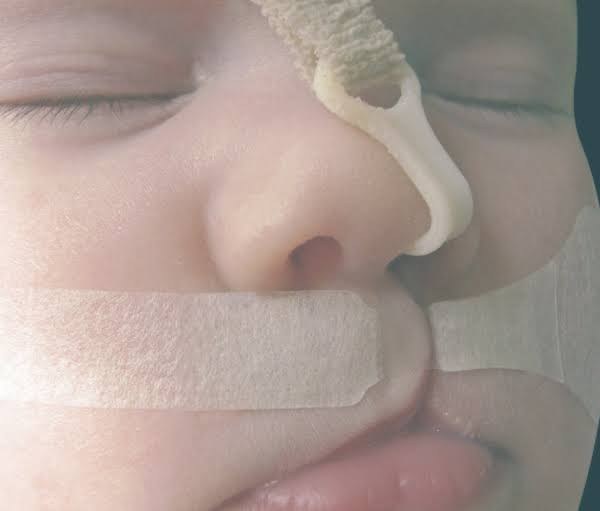 DynaCleft elastic adhesive strip applied across an infant cleft lip