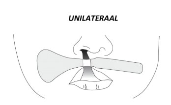 Line drawing of unilateral DynaCleft strip placement across the cleft