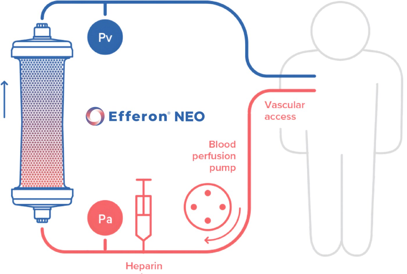 Schematic of an Efferon NEO cytokine adsorption circuit with blood pump and vascular access