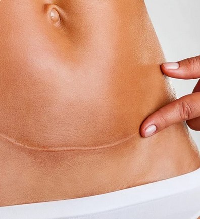 Close-up of a healed abdominal surgical scar
