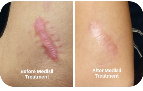 Photographs of a scar before and after MediSil silicone treatment