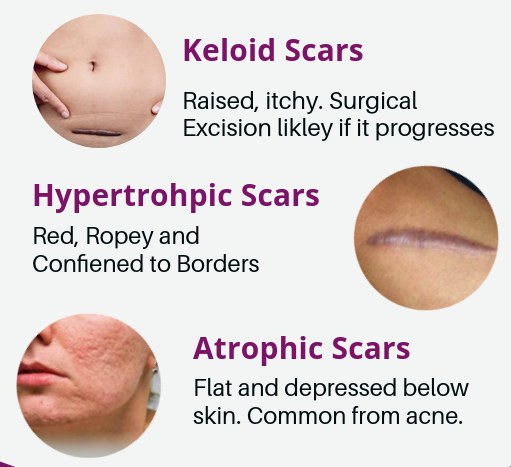 Chart of keloid, hypertrophic and atrophic scar types with descriptions