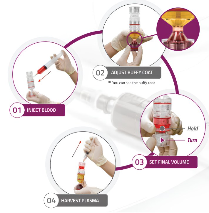 Four-step Novastem workflow: inject blood, adjust buffy coat, set final volume, harvest plasma