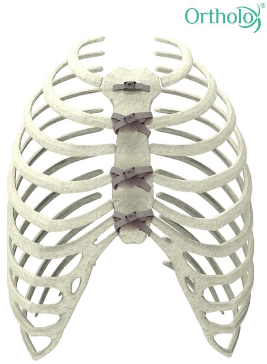 Ortholox sternal closure cables fitted across a sternum on an anatomical rib cage model