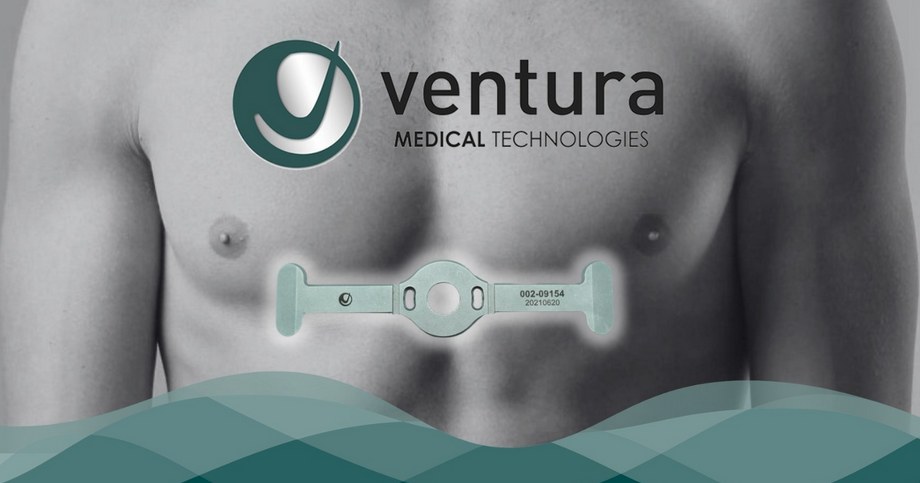 Ventura Medical Pectus Up elevation plate positioned on the chest wall