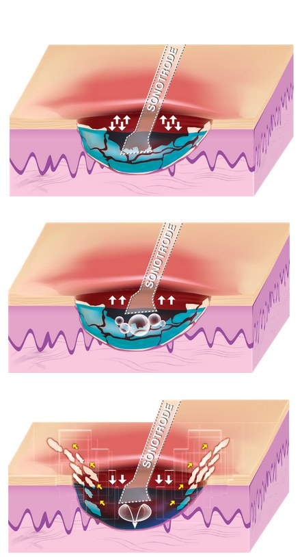 Three-stage diagram of ultrasound-assisted wound cleansing in tissue