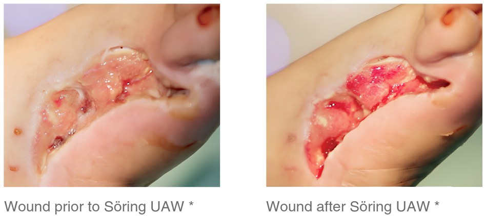 Clinical photographs of a wound before and after Söring ultrasound-assisted wound debridement