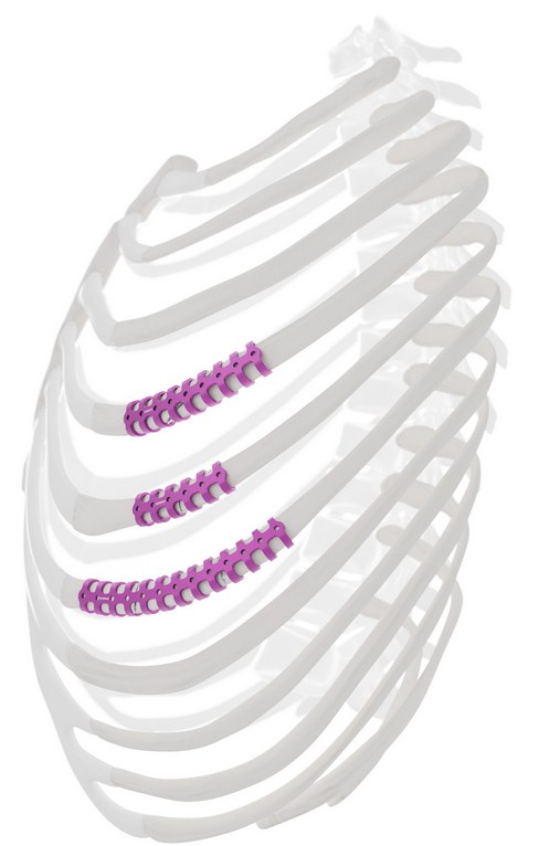 StraCos clips fixing three consecutive rib fractures on a rib cage render