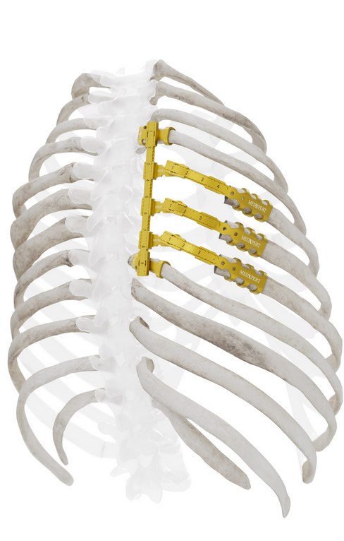Lateral rib cage render with StraTos bridges spanning a chest wall defect