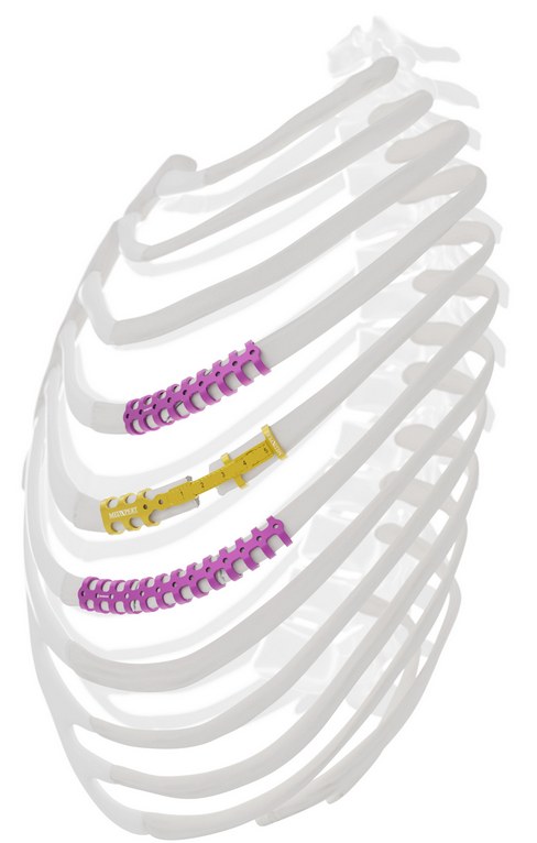 Lateral rib cage render showing StraCos clips and StraTos bridges used together