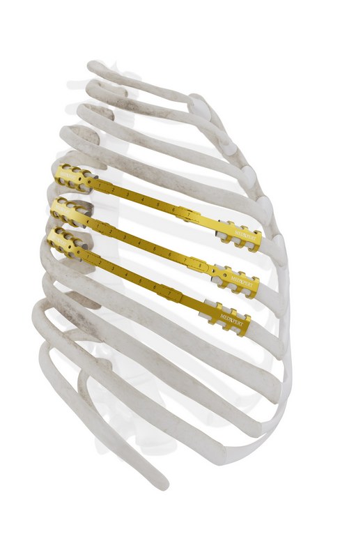 Multiple StraTos bridges fixed along the lateral ribs