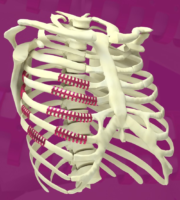 MedXpert StraTos rib fixation clips and bridges on an anatomical rib cage