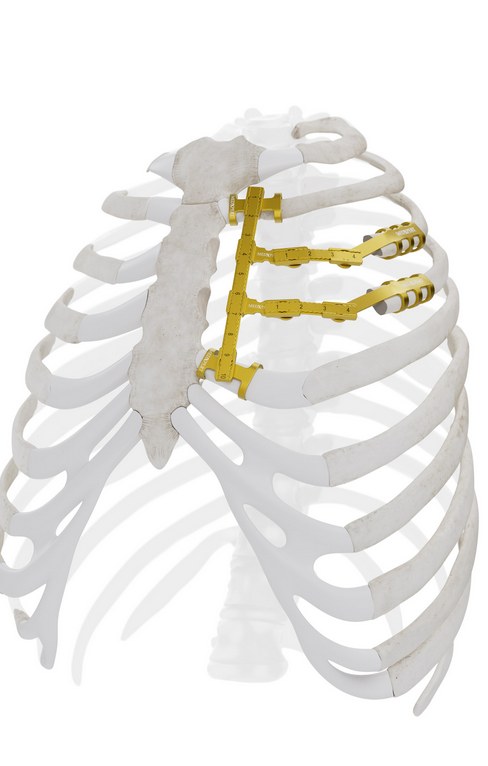 Anterior sternum render with StraTos bridges after sternal resection