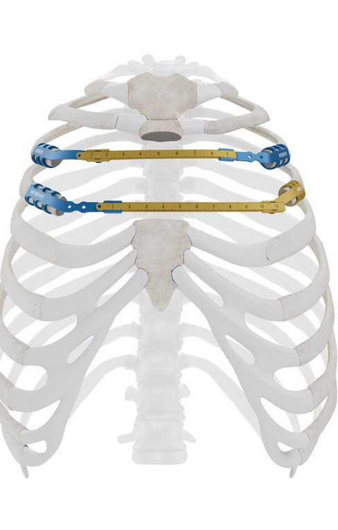 Sternal reconstruction with a horizontal StraTos bridge and clip anchors