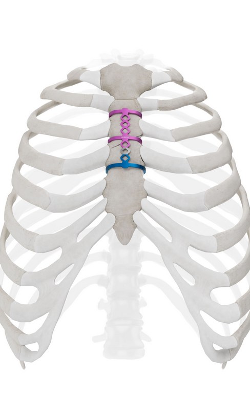 Anterior view of a sternum closed with StraCos clips and a StraTos bridge
